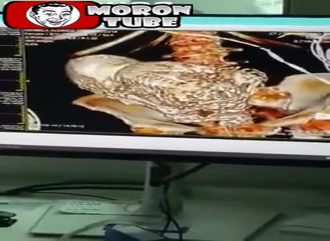 Video :When a calcified stone baby is found within her, she is admitted to the hospital for bladder stones